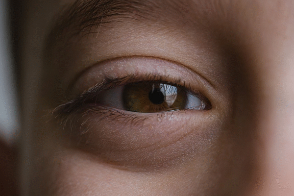 Puffy eyes and under-eye bags caused by tiredness or fluid retention.