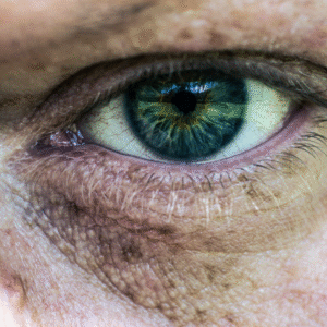 Man showing visible under eye dark circle, highlighting common signs of fatigue and skin concerns