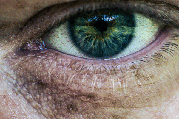 Man showing visible under eye dark circle, highlighting common signs of fatigue and skin concerns